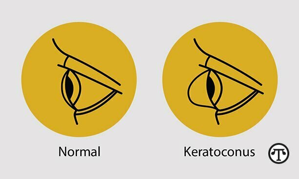 KC发生在角膜变薄、变弱，形成圆锥形凸起并扭曲视力时.