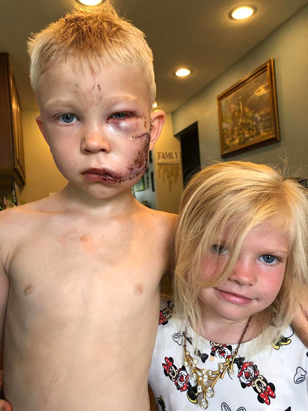 Bridger Walker stood between his little sister and a charging dog. He later said, ‘If someone had to die, I thought it should be me,’ wrote his aunt, Nikki Walker, in an Instagram post that went viral. Bridger received about 90 stitches.