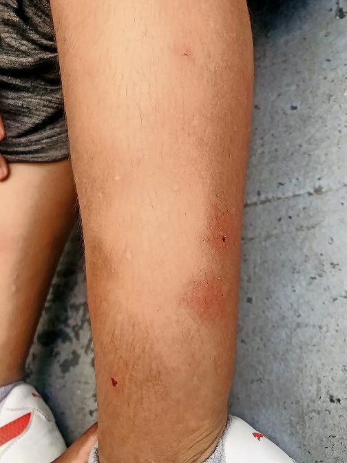 One of the asylum seekers staying at the Van Cortlandt Motel shows the bug bites they had during their stay there.