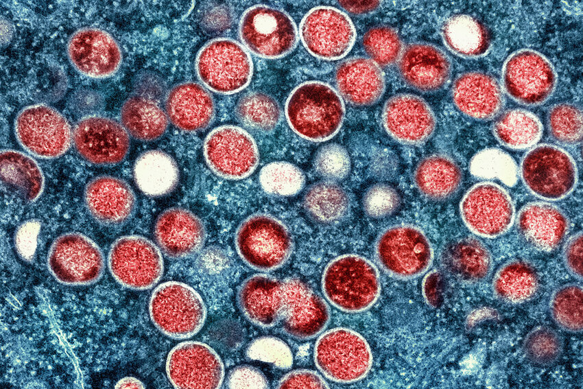 This colorized electron microscope image provided by the National Institute of Allergy and Infectious Diseases shows mpox particles, red, found within an infected cell, blue, cultured in a laboratory in Fort Detrick, Md. A study released by the U.S. Centers for Disease Control and Prevention on Thursday, May 25, 2023, suggests dozens of U.S. cities are at risk for mpox outbreaks this summer. Health officials say they are working to prevent the scale of infections that surprised the nation the previous summer.