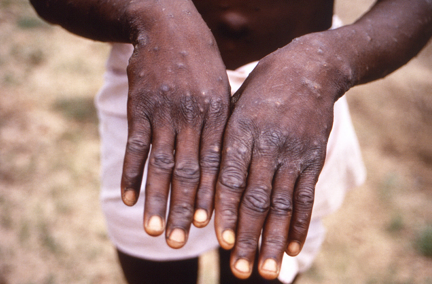 The dorsal surfaces of the hands of a monkeypox case patient, who was displaying the appearance of the characteristic rash during its recuperative stage. The expanding monkeypox outbreak in more than 70 countries is an “extraordinary” situation that qualifies as a global emergency, the World Health Organization chief said July 23.